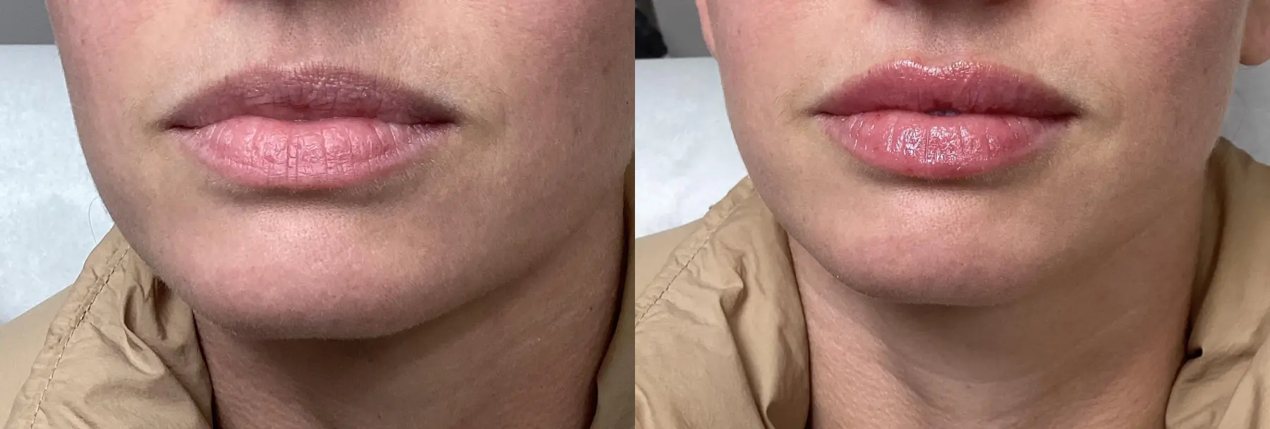 Juvederm / Fillers: Patient 1 - Before and After  