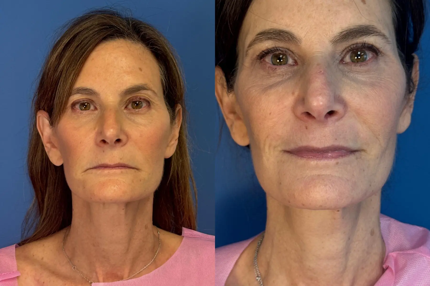 Laser Skin Resurfacing - Face: Patient 3 - Before and After  
