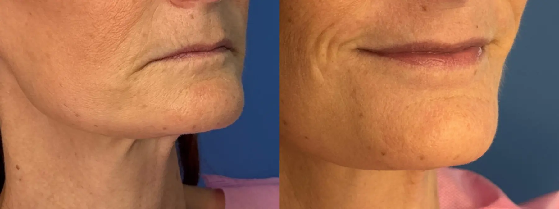 Laser Skin Resurfacing - Face: Patient 2 - Before and After 2