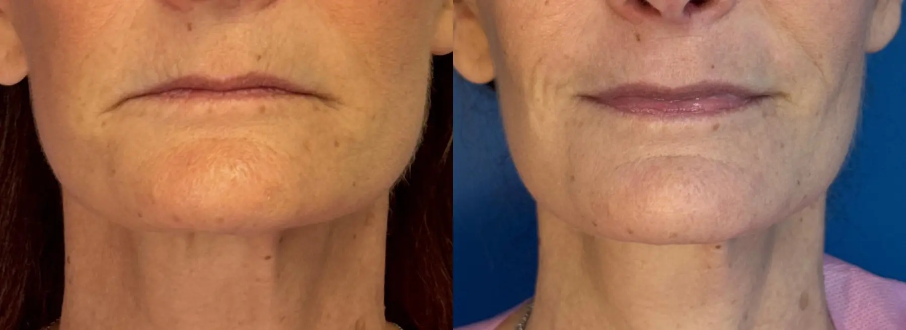 Laser Skin Resurfacing - Face: Patient 2 - Before and After  