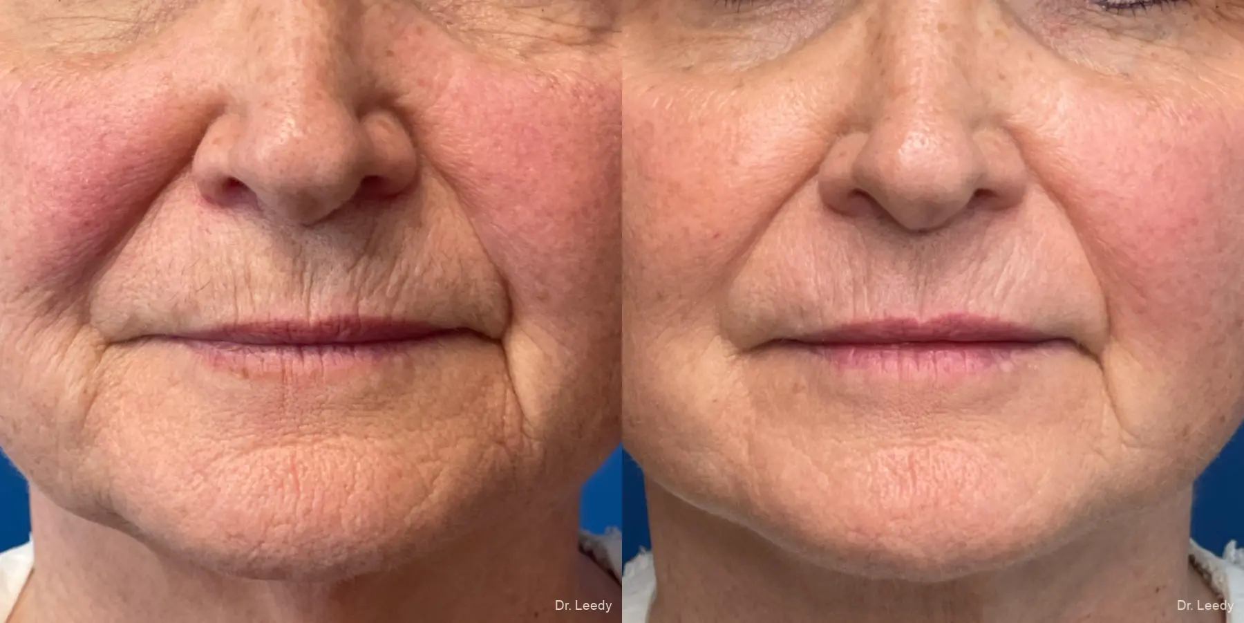 Laser Skin Resurfacing - Face: Patient 1 - Before and After  