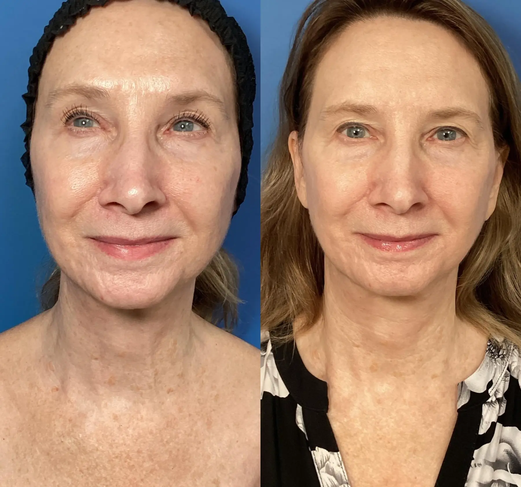 Laser Skin Resurfacing: Patient 1 - Before and After  