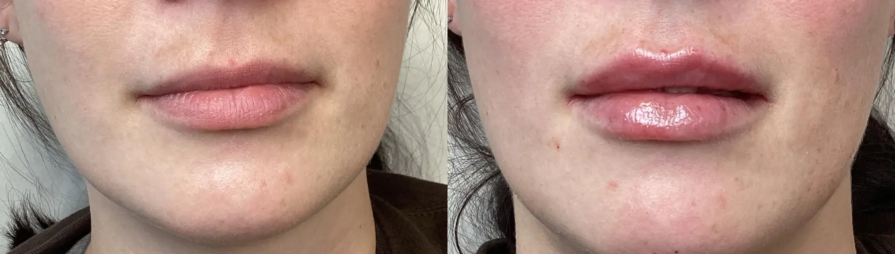 Lip Filler: Patient 1 - Before and After  