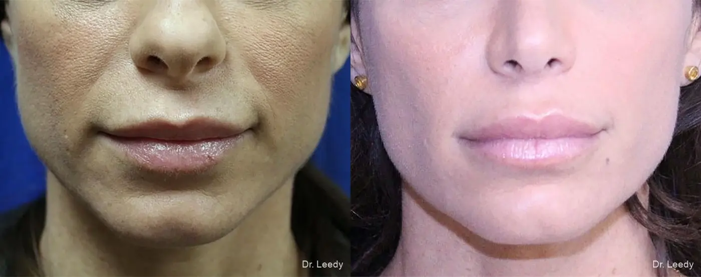 Lip Lift: Patient 1 - Before and After 1