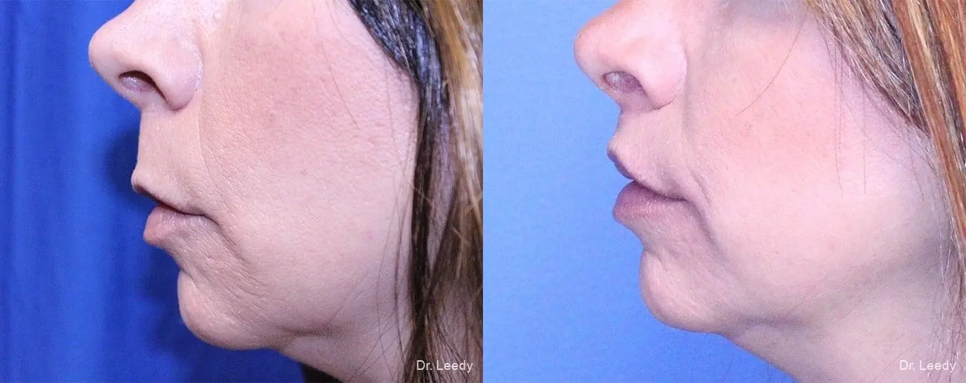 Lip Lift: Patient 4 - Before and After 5