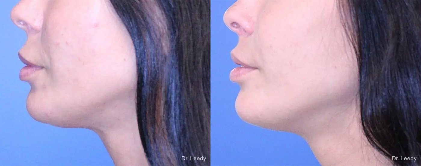Lip Lift: Patient 3 - Before and After 5