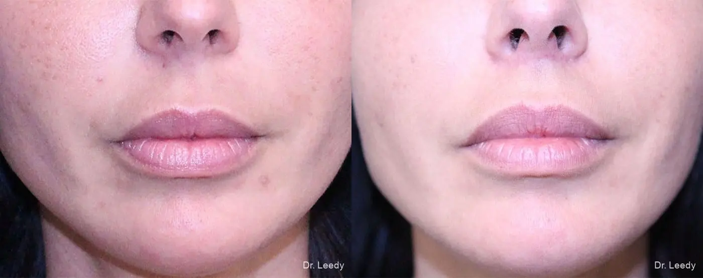 Lip Lift: Patient 3 - Before and After  