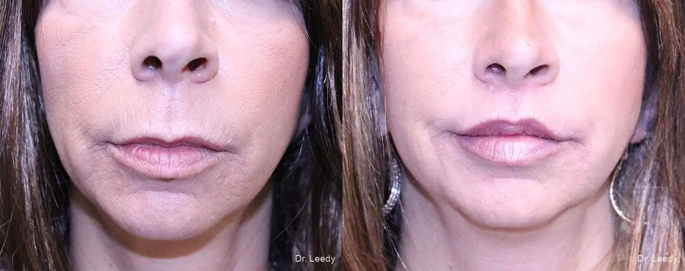 Lip Lift: Patient 4 - Before and After  
