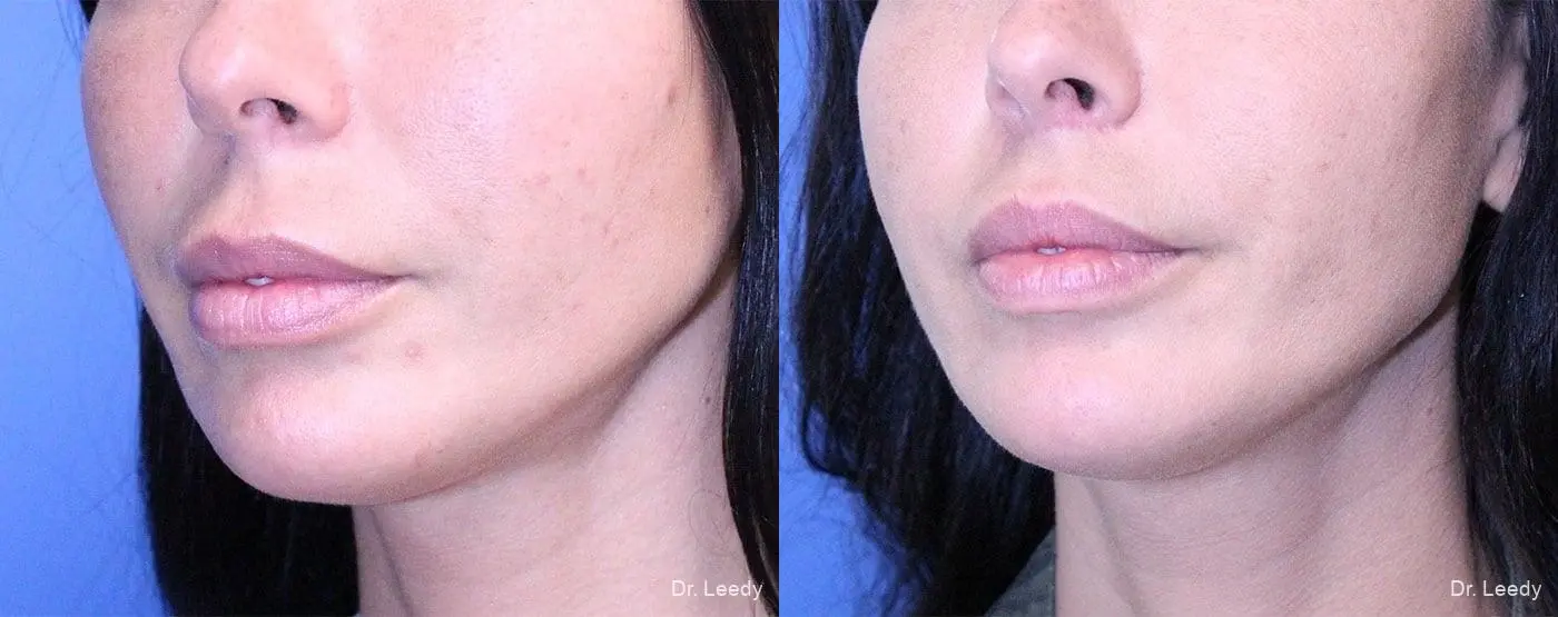 Lip Lift: Patient 3 - Before and After 4