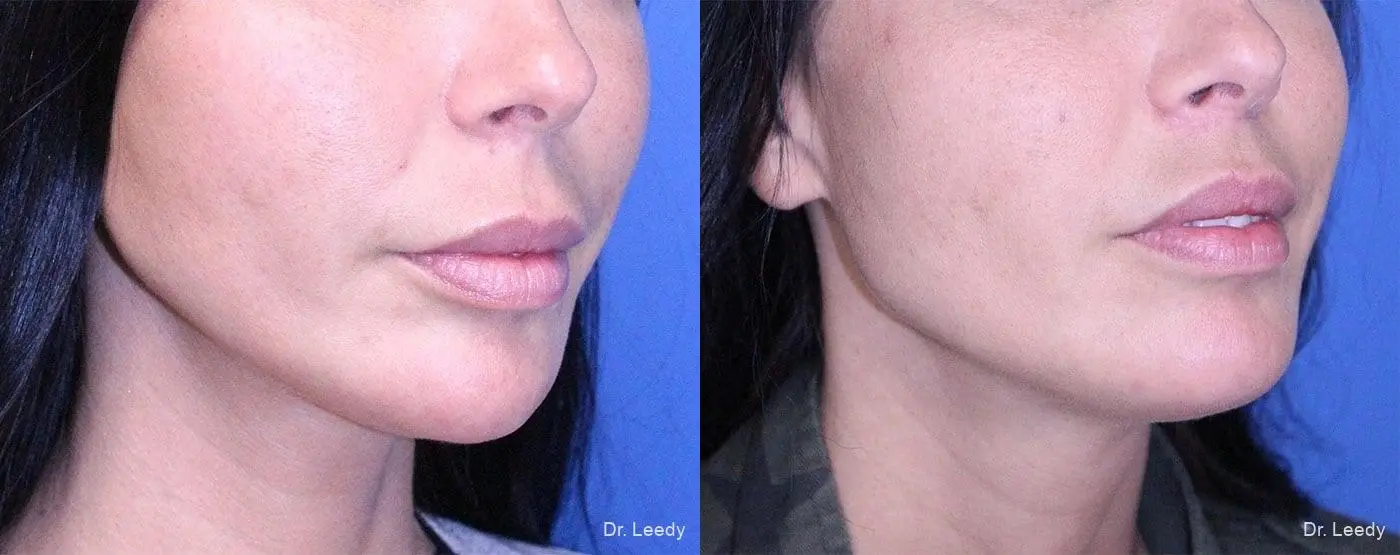 Lip Lift: Patient 3 - Before and After 2