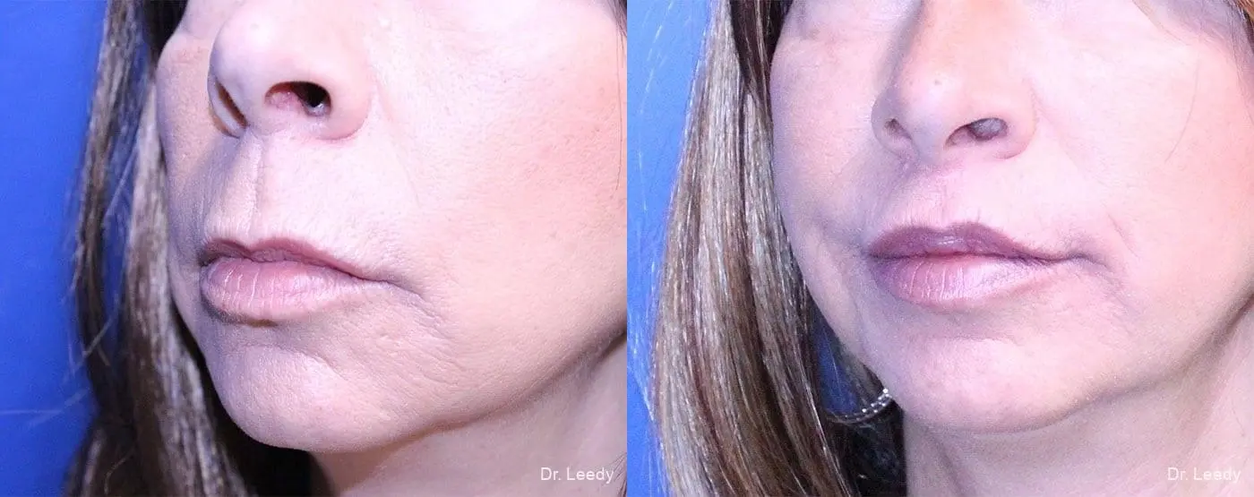 Lip Lift: Patient 4 - Before and After 4