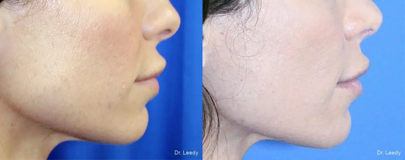 Lip Lift: Patient 1 - Before and After 3