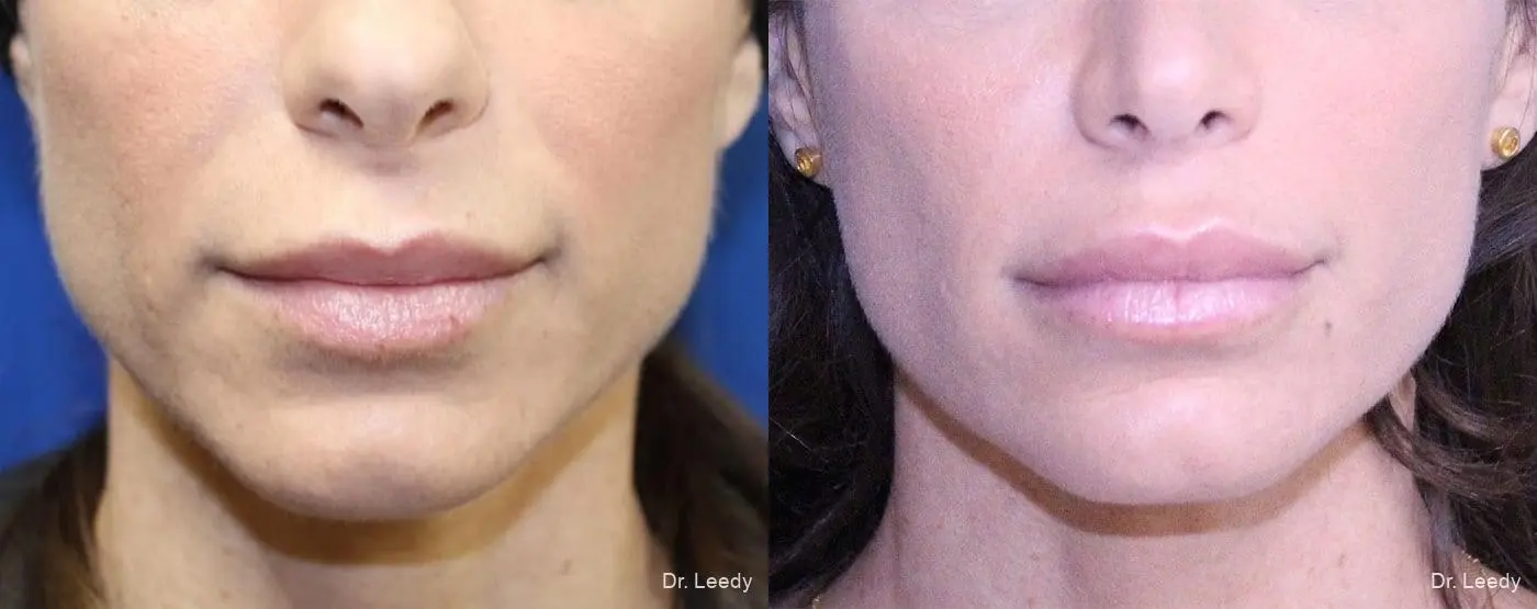 Lip Lift: Patient 2 - Before and After 1