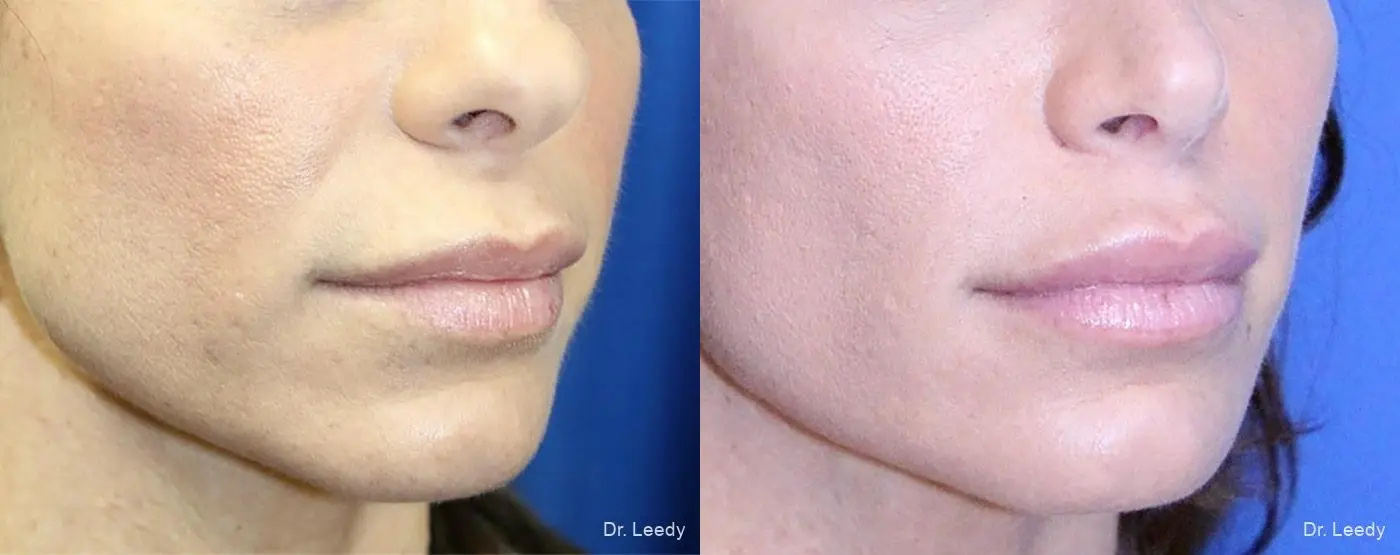 Lip Lift: Patient 1 - Before and After 2