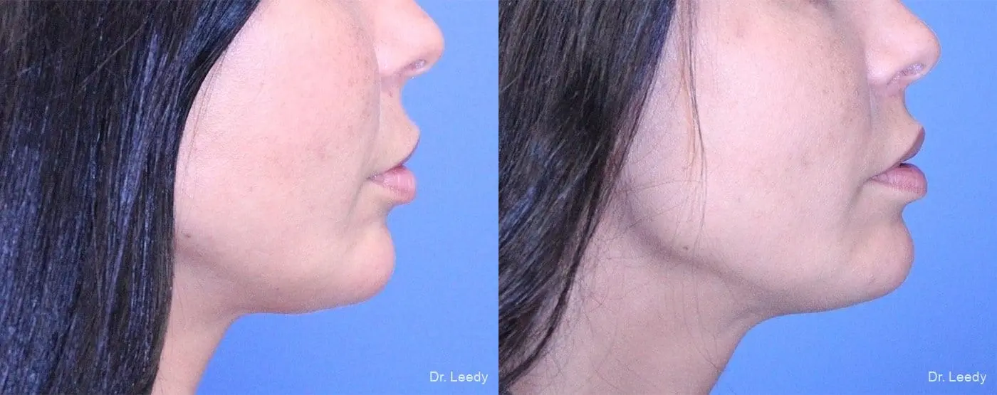 Lip Lift: Patient 3 - Before and After 3