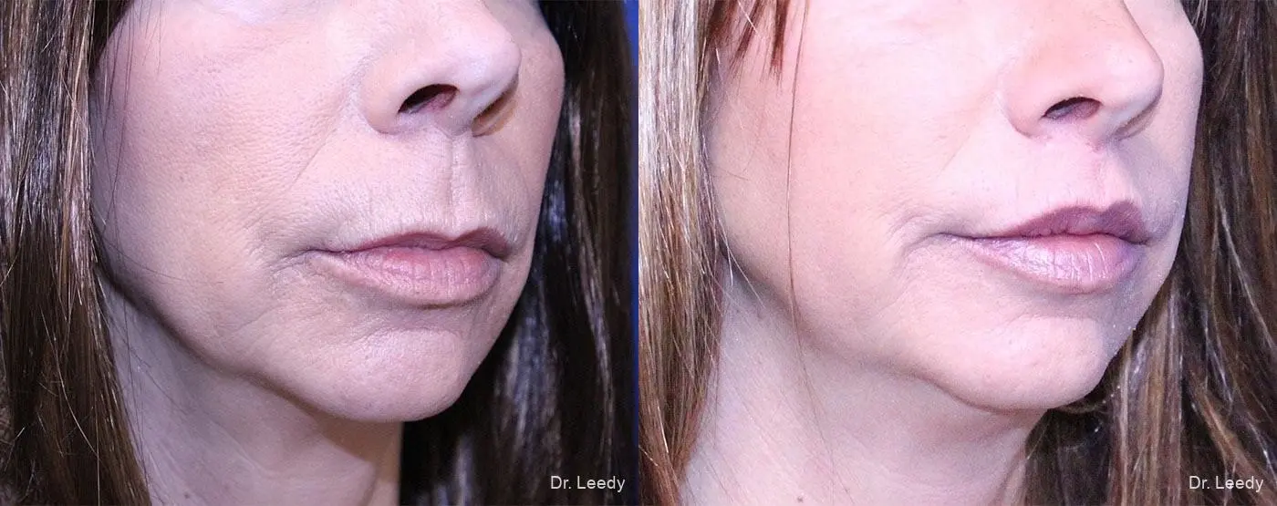 Lip Lift: Patient 4 - Before and After 2