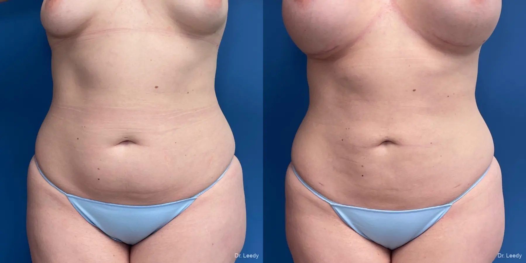 Liposuction: Patient 6 - Before and After  