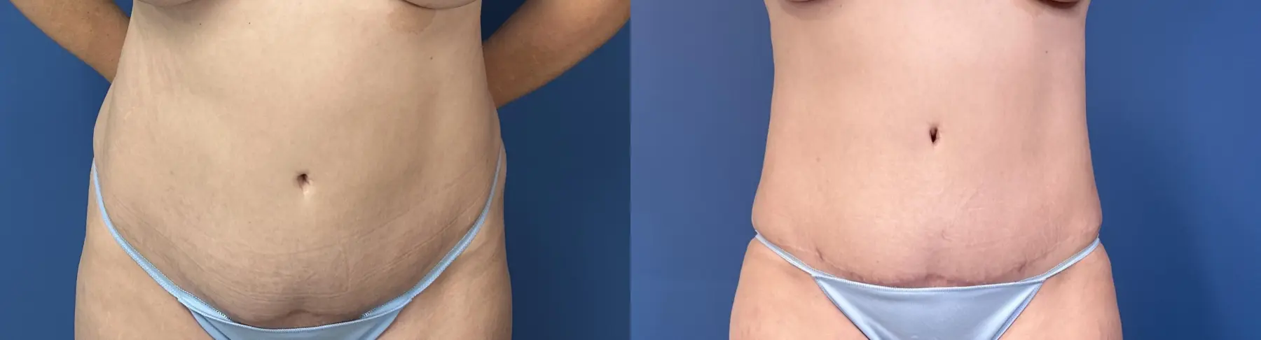 Liposuction: Patient 5 - Before and After  