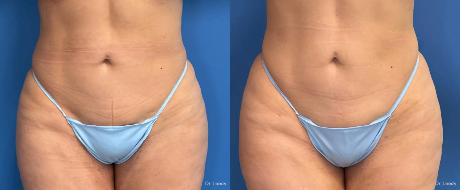 Liposuction: Patient 10 - Before and After  