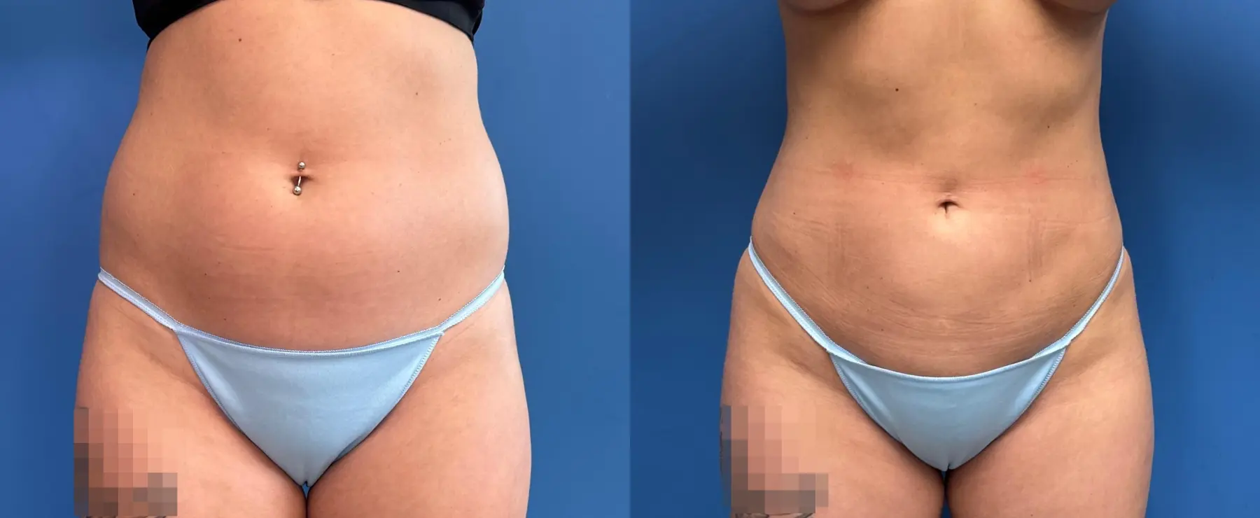 Liposuction: Patient 7 - Before and After  