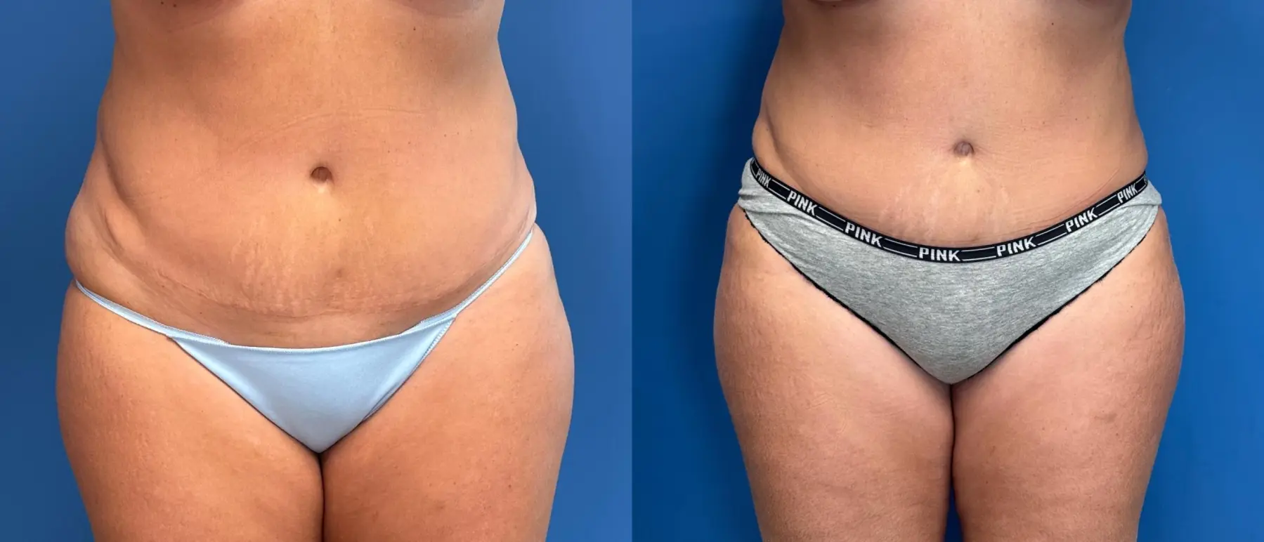 Liposuction: Patient 7 - Before and After 1