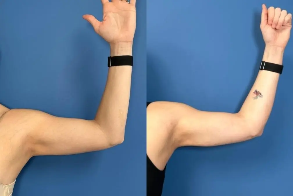 Liposuction: Patient 1 - Before and After  