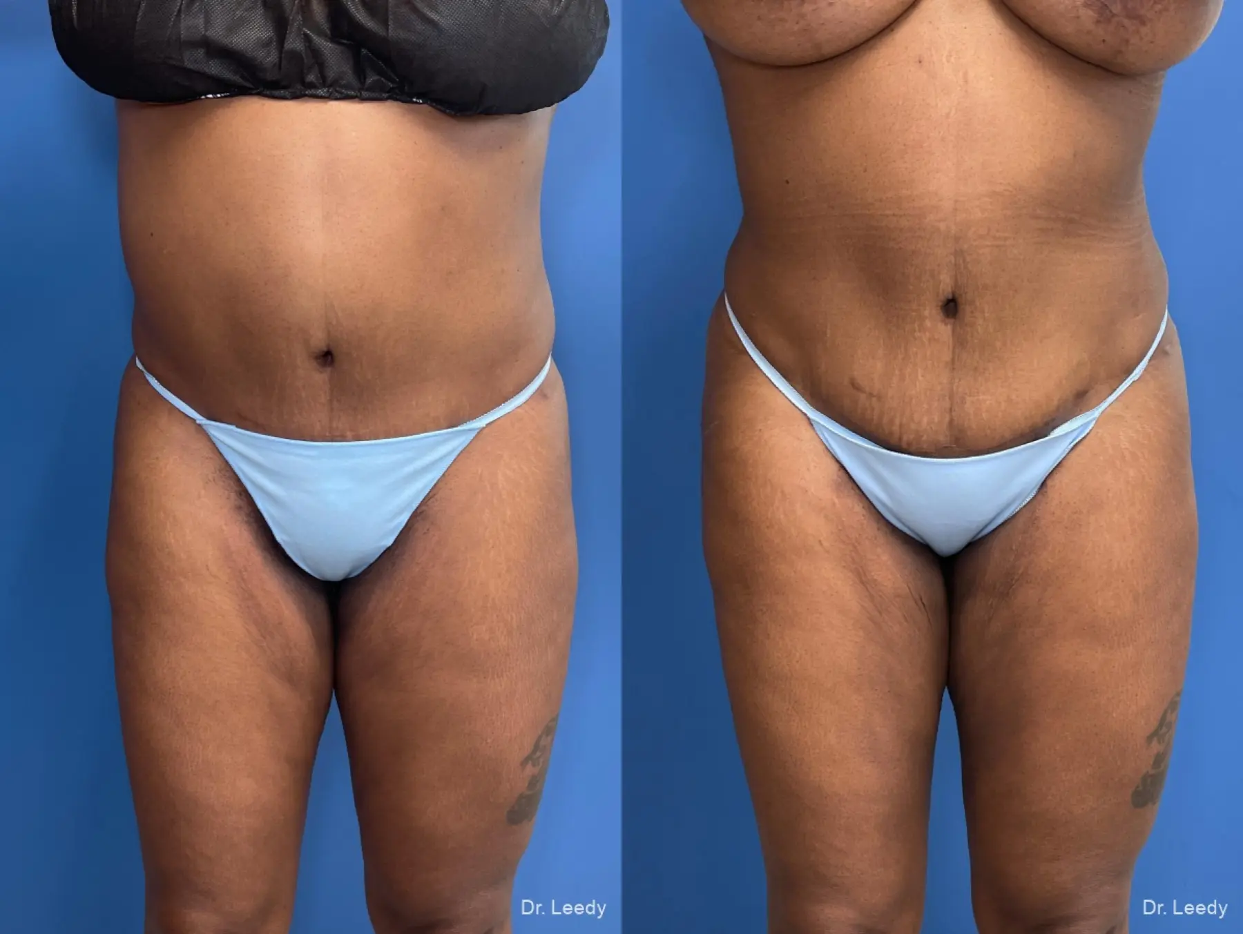 Liposuction: Patient 4 - Before and After  