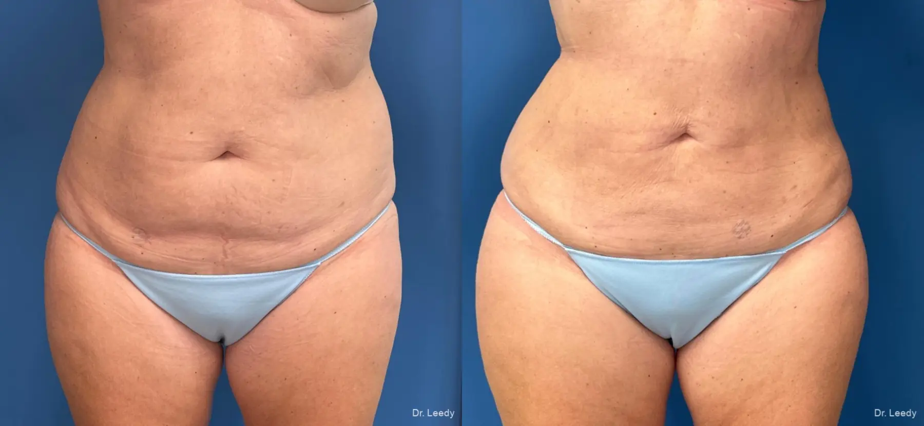Liposuction: Patient 8 - Before and After  
