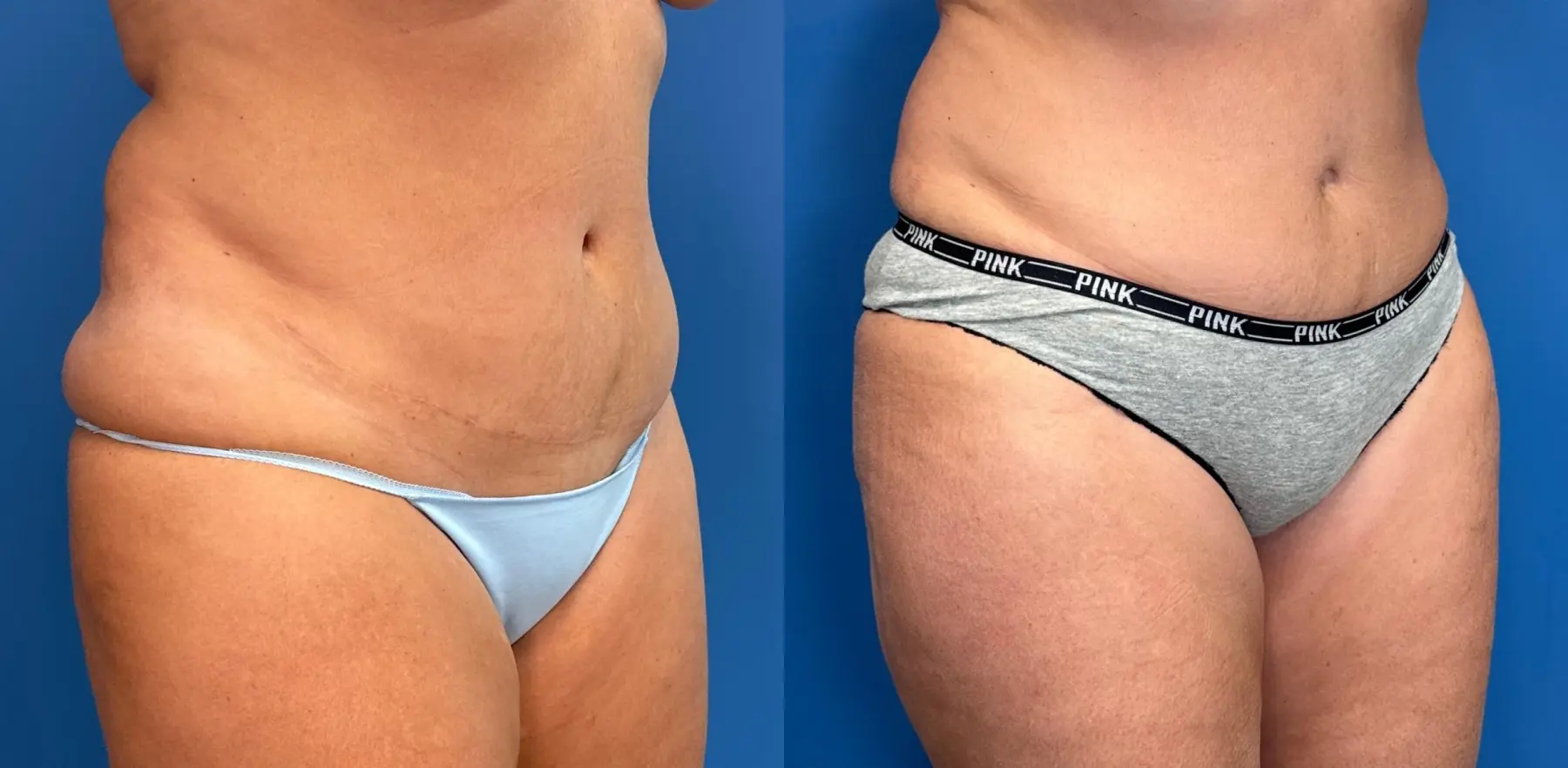 Liposuction: Patient 7 - Before and After 2