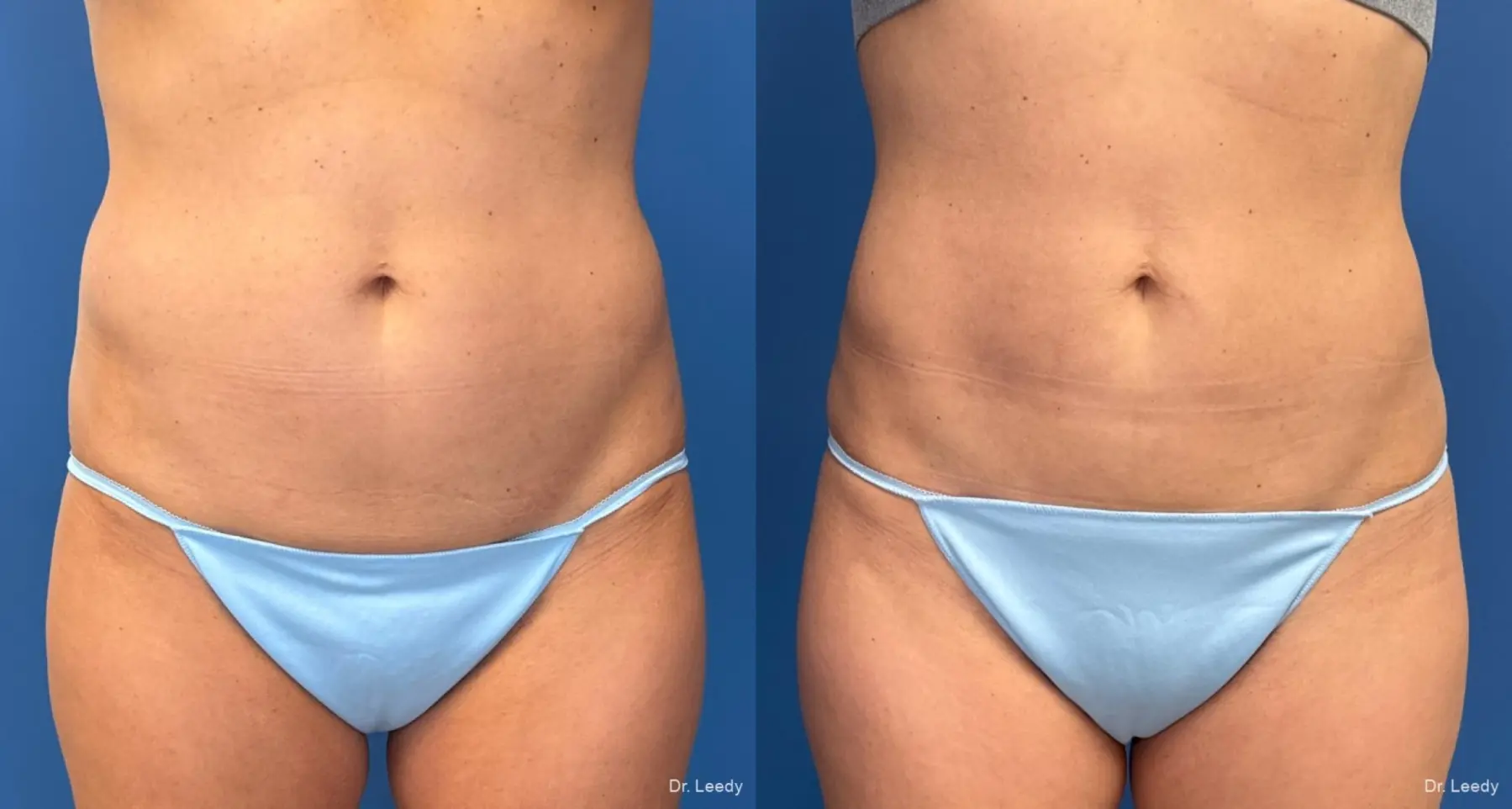 Liposuction: Patient 9 - Before and After  