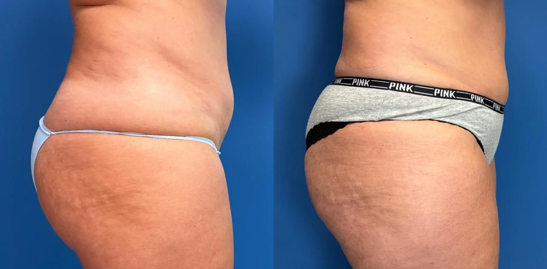 Liposuction: Patient 7 - Before and After 3