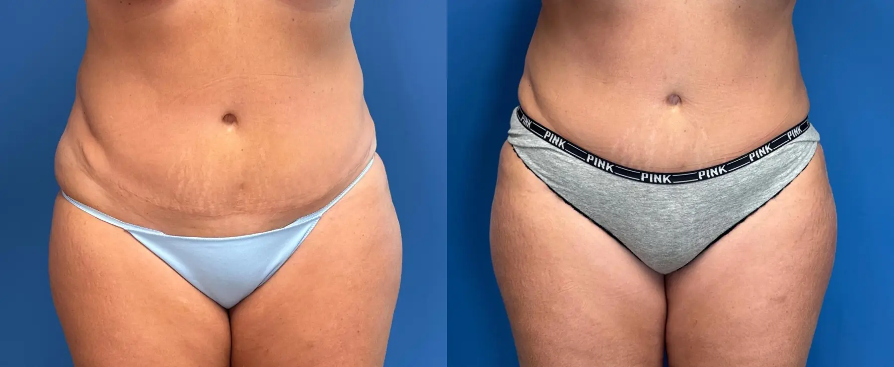 Liposuction: Patient 13 - Before and After  