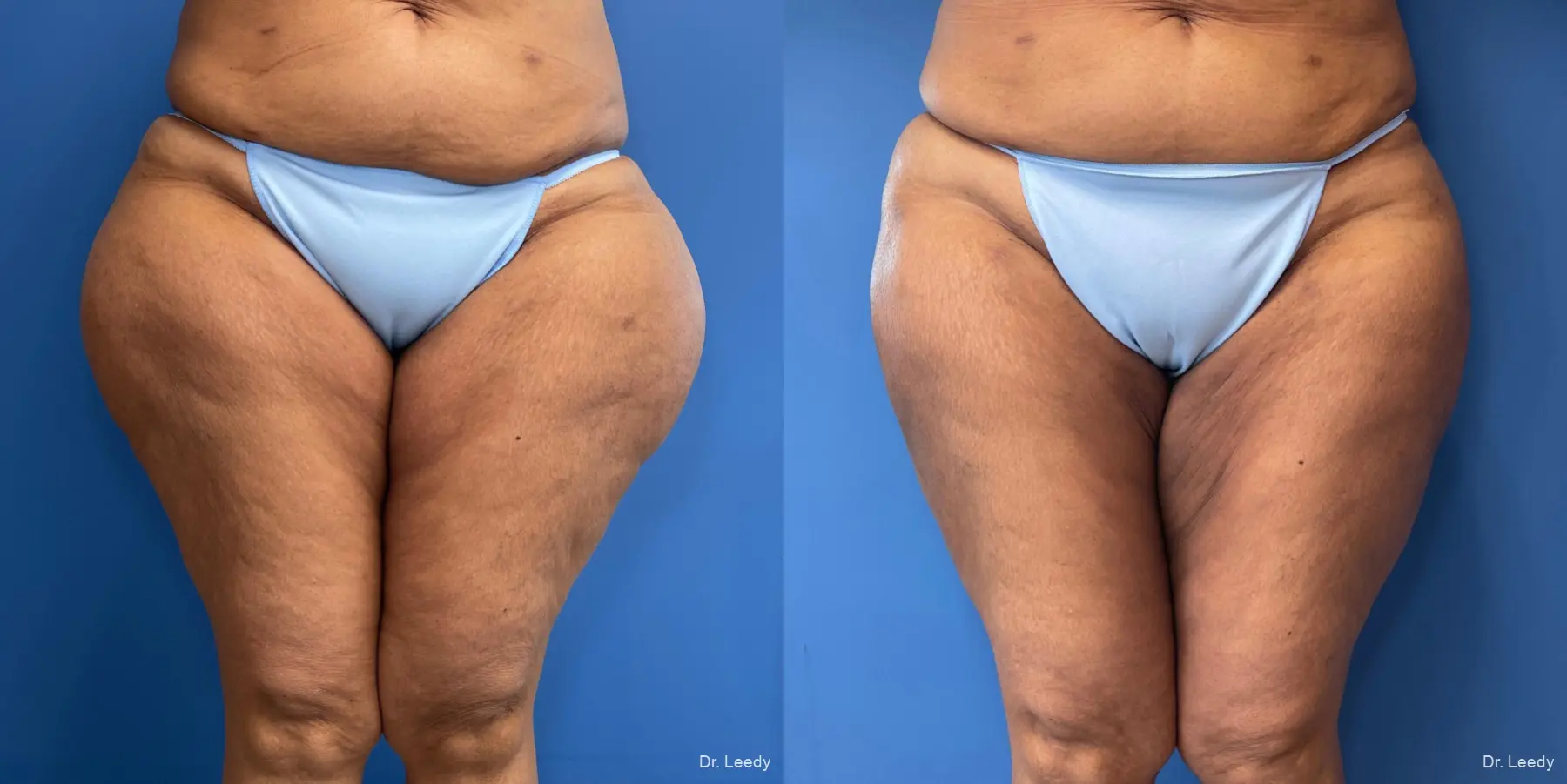 Liposuction: Patient 1 - Before and After  