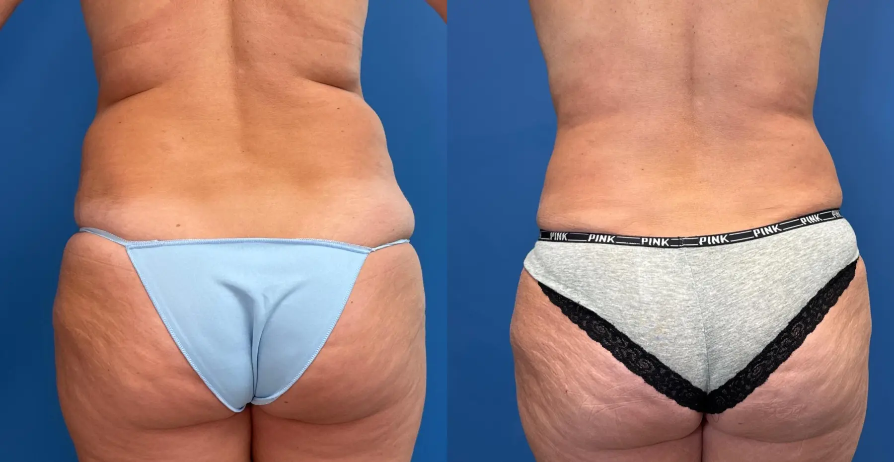 Liposuction: Patient 7 - Before and After 4