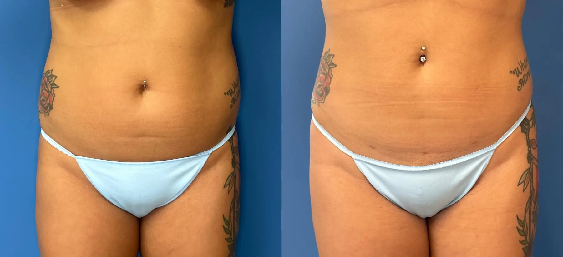 Liposuction: Patient 12 - Before and After  