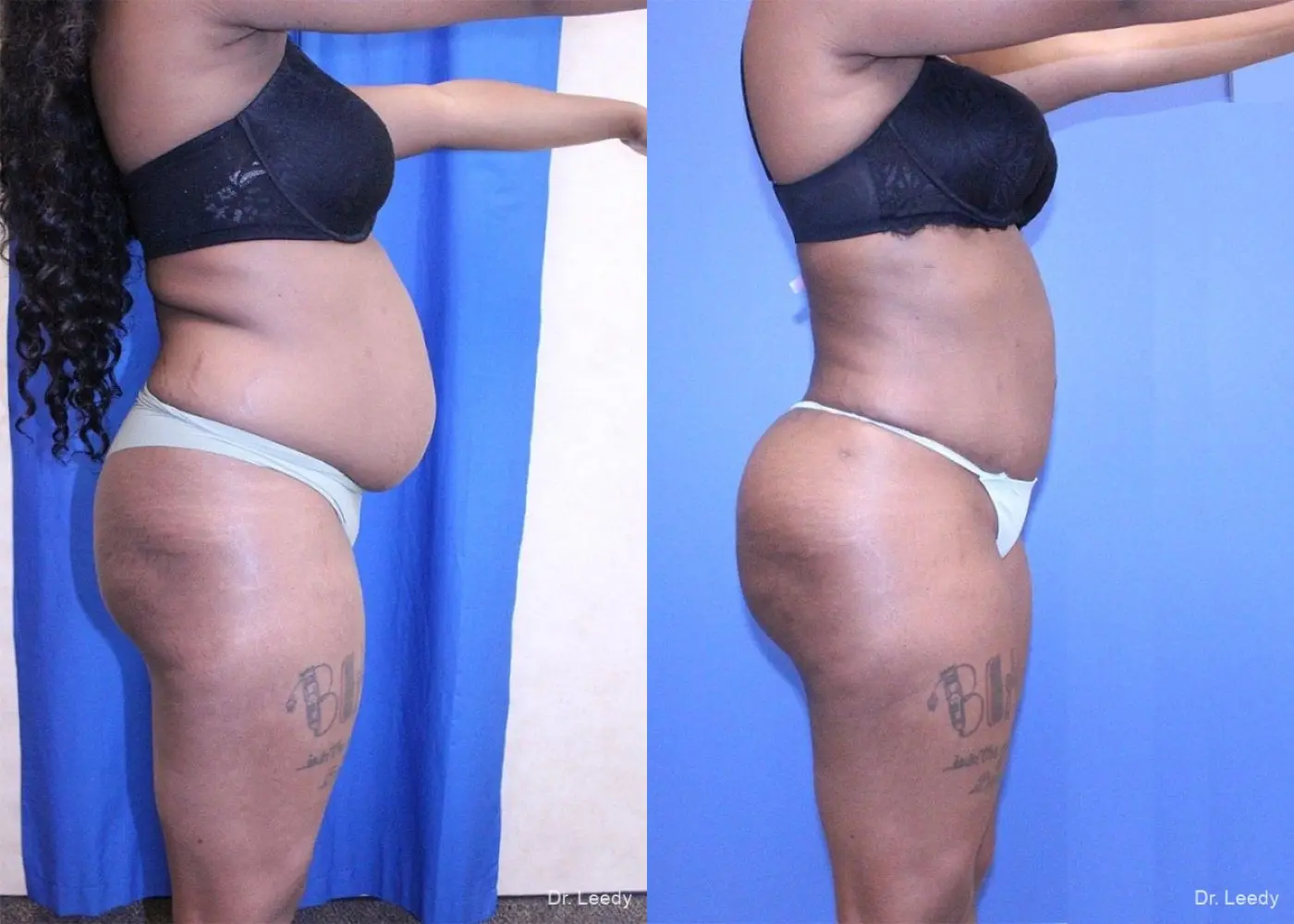 Liposuction With Brazillian Butt Lift: Patient 1 - Before and After 4