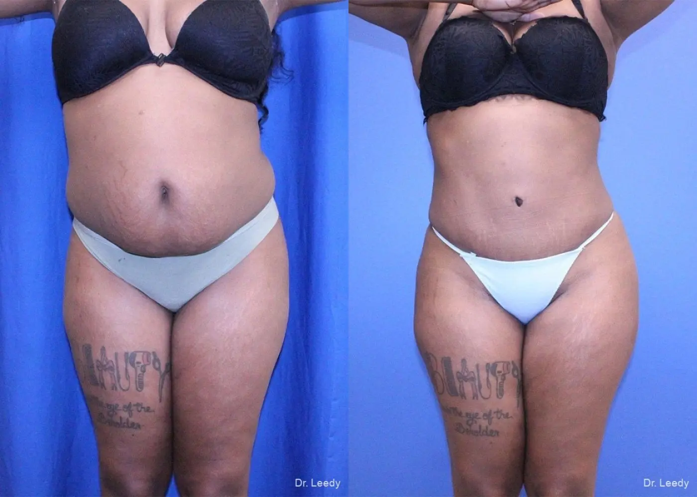 Liposuction With Brazillian Butt Lift: Patient 1 - Before and After 1