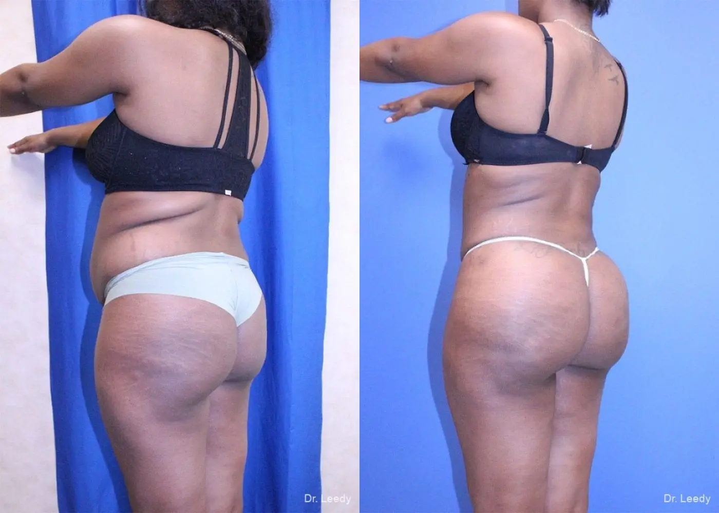 Liposuction With Brazillian Butt Lift: Patient 1 - Before and After 6