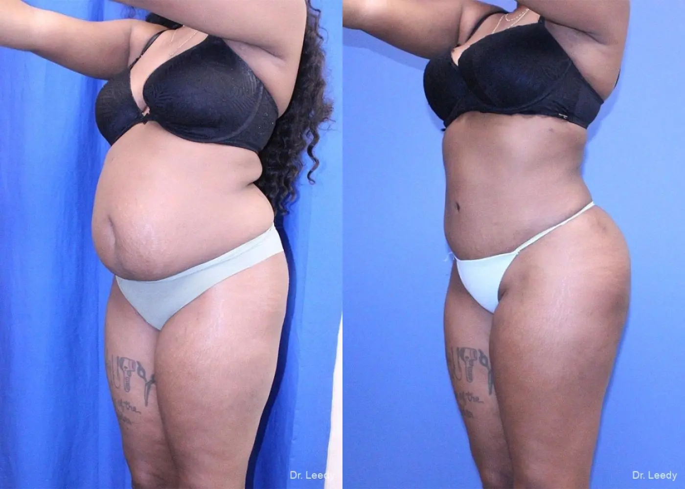 Liposuction With Brazillian Butt Lift: Patient 1 - Before and After 5