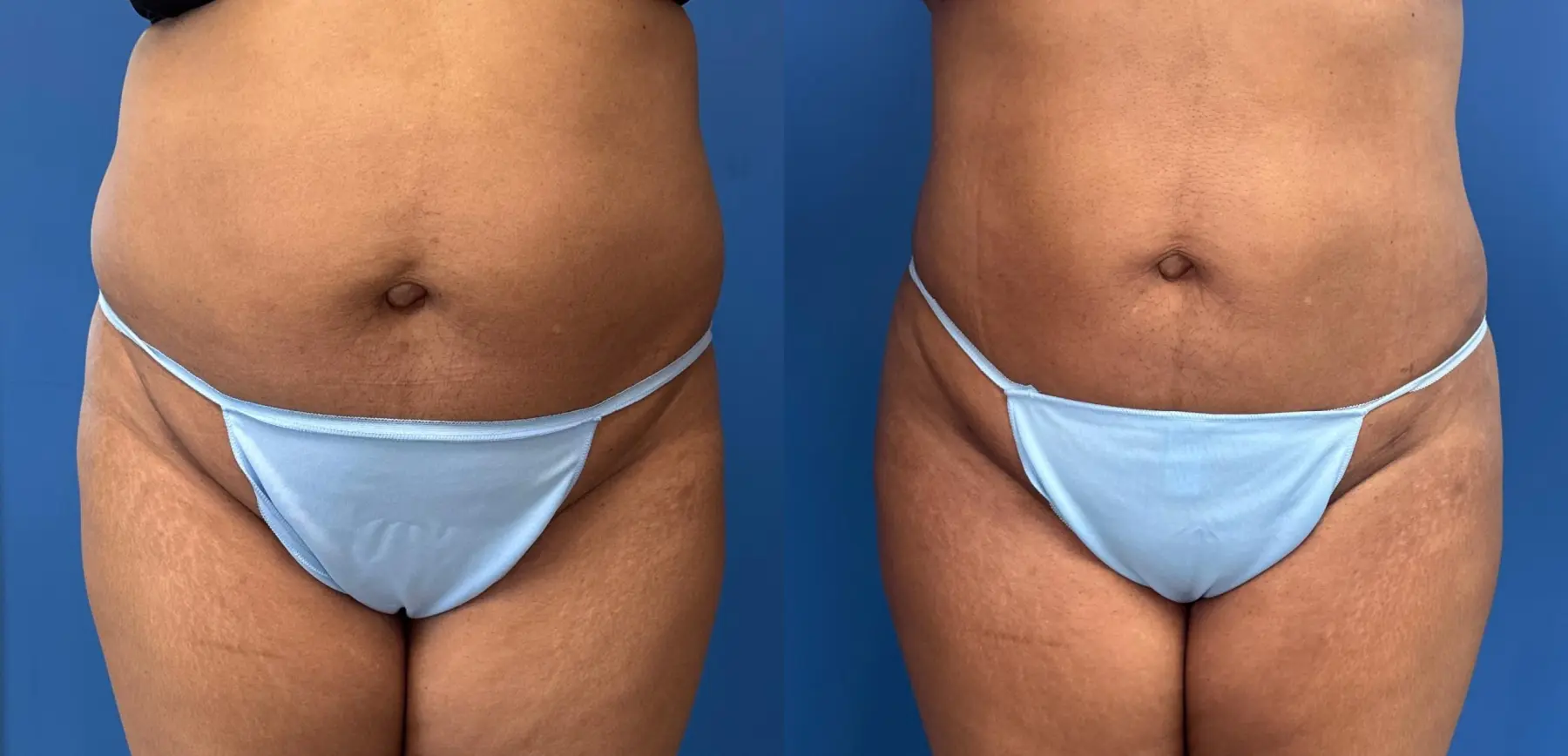 Liposuction With Brazillian Butt Lift: Patient 2 - Before and After  