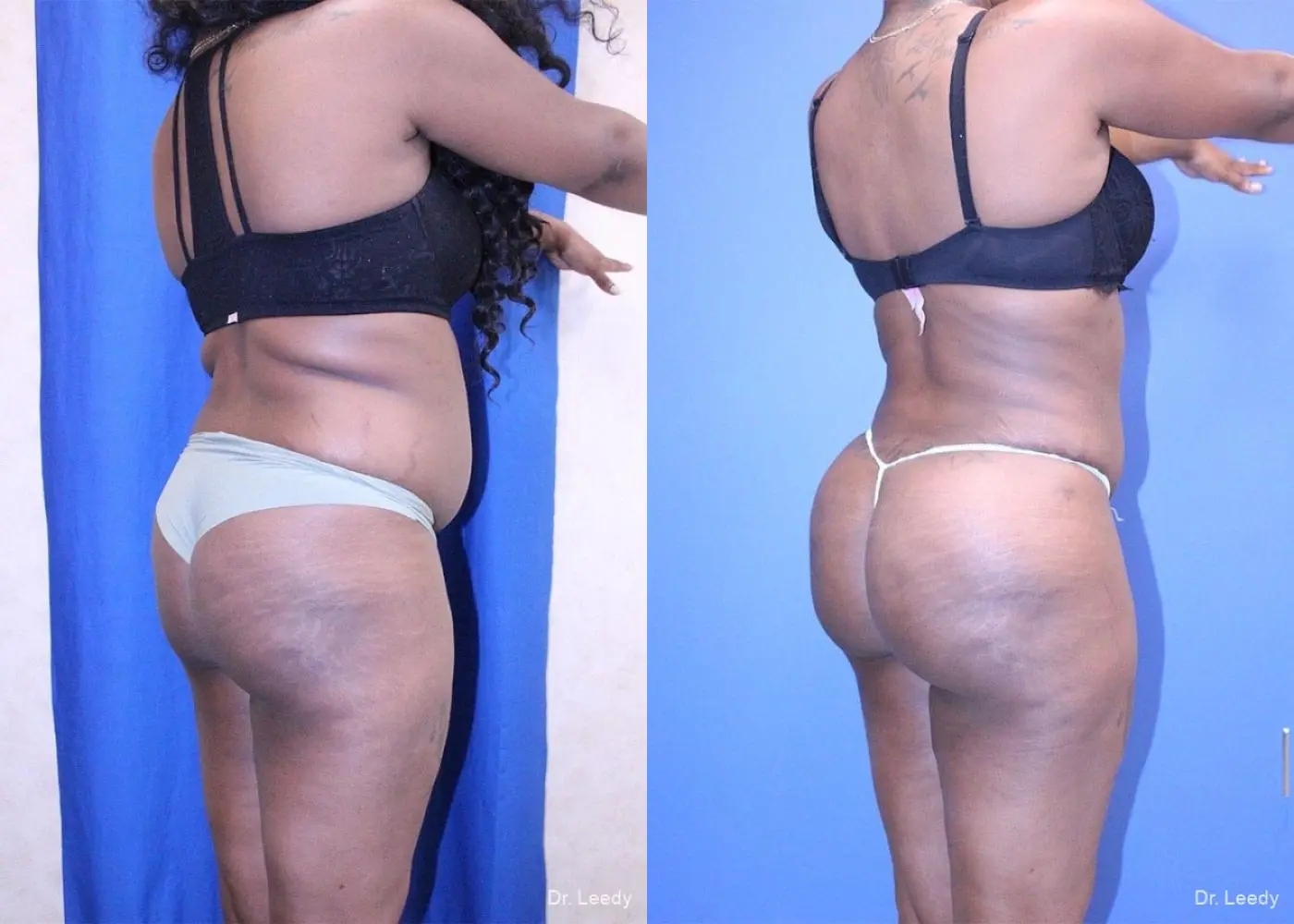 Liposuction With Brazillian Butt Lift: Patient 1 - Before and After 3