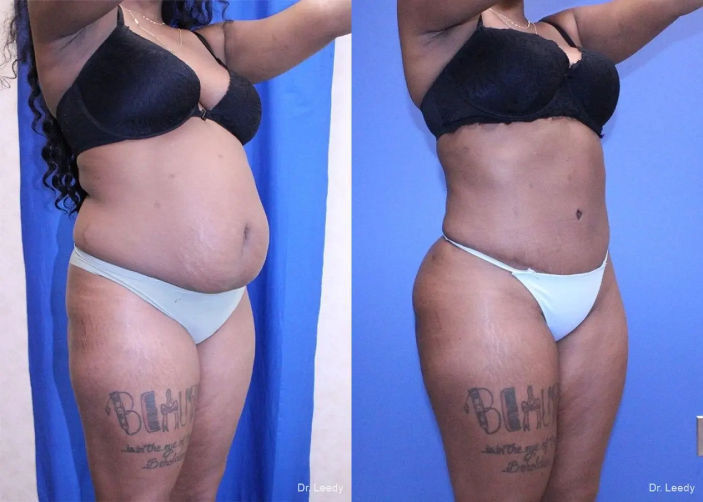 Liposuction With Brazillian Butt Lift: Patient 1 - Before and After 2