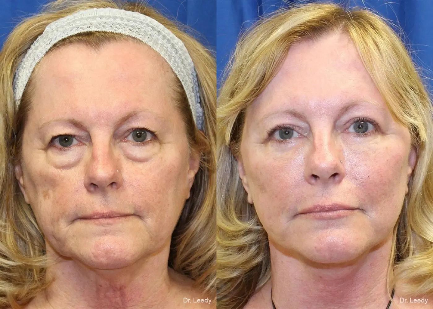 Lower Blepharoplasty: Patient 1 - Before and After 1