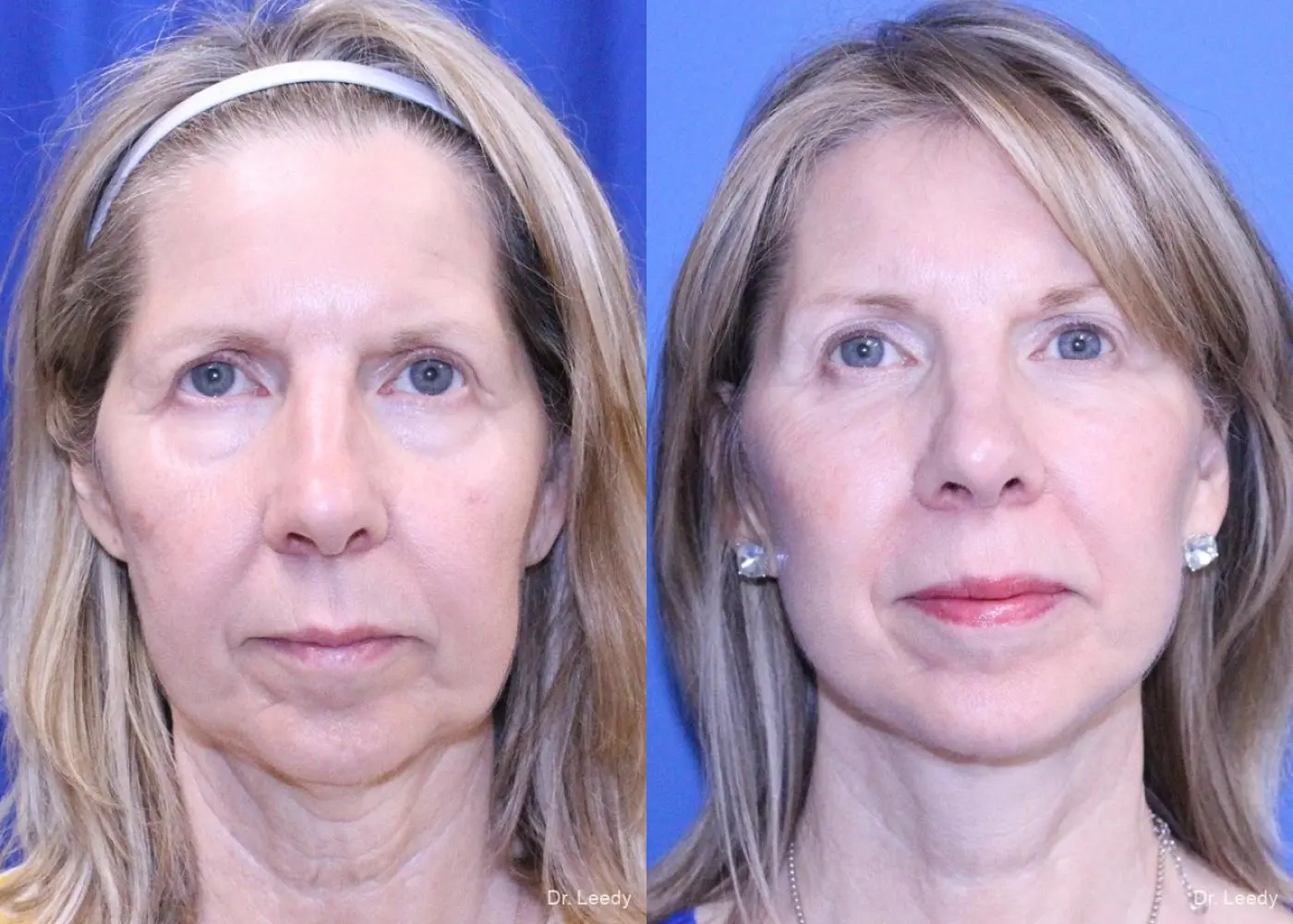 Lower Blepharoplasty: Patient 4 - Before and After  