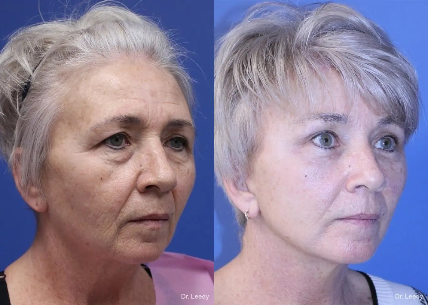 Lower Blepharoplasty: Patient 3 - Before and After 2