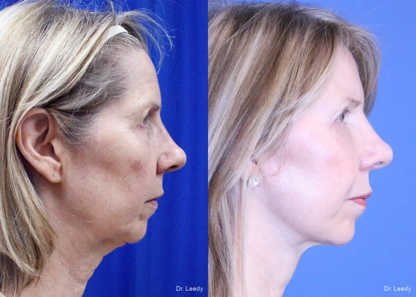 Lower Blepharoplasty: Patient 4 - Before and After 3