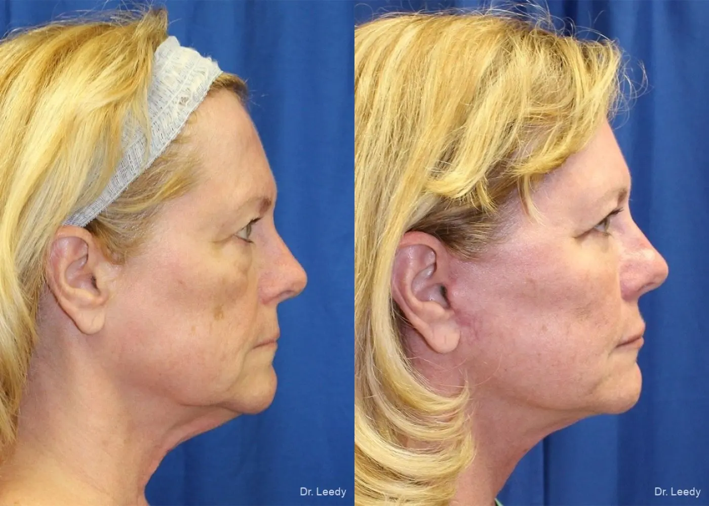 Lower Blepharoplasty: Patient 1 - Before and After 3