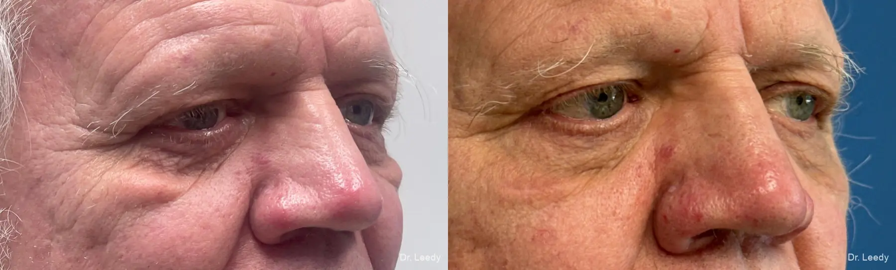 Lower-blepharoplasty-for-men: Patient 2 - Before and After  