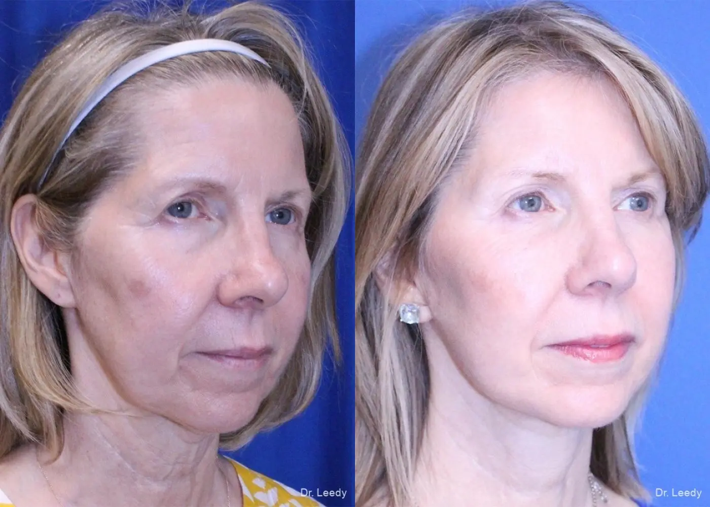 Lower Blepharoplasty: Patient 4 - Before and After 2