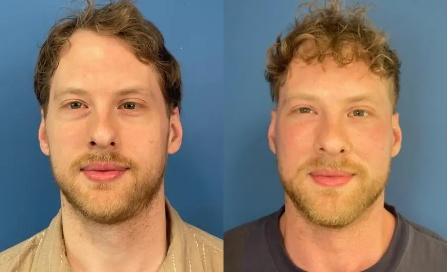 Lower-blepharoplasty-for-men: Patient 1 - Before and After  